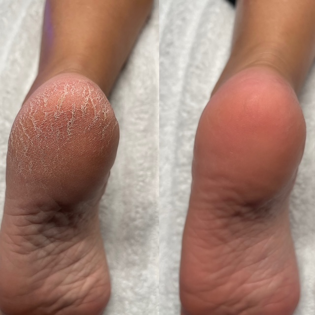 cracked peeling feet made smooth with foot facial